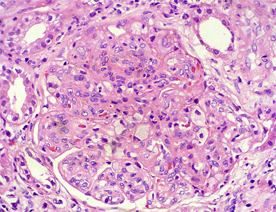 Hypernephroides Nephrotic_Nephritic_Syndrome